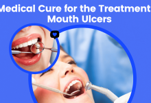 Medical Cure for the Treatment of Mouth Ulcers